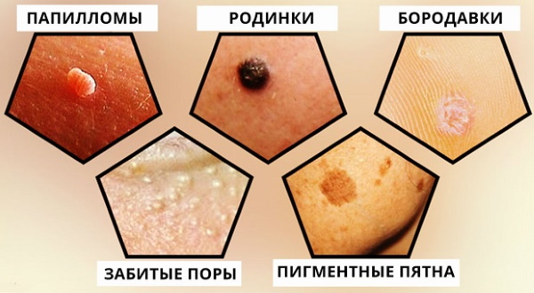 Removal of papillomas on the face with a laser, nitrogen, radio wave method, ointments from a pharmacy, folk remedies