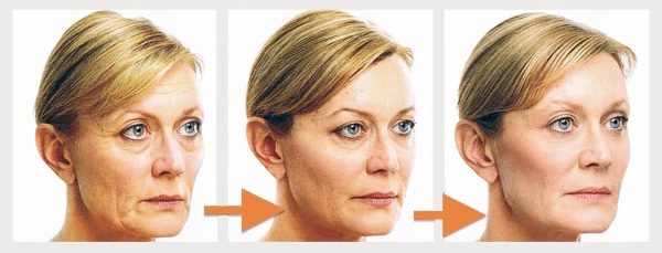 Facelift for the face. Effective exercises, anti-puffiness techniques, for tightening the oval, before and after photos