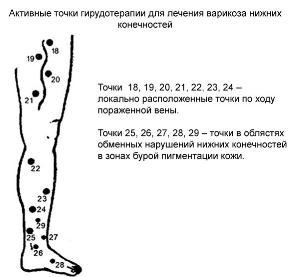 Hirudoterapia in cosmetologia per vene varicose, cellulite, smagliature. Formazione, foto prima e dopo, recensioni