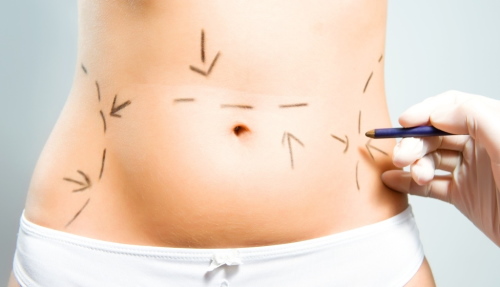 Laser liposuction of the abdomen. Photo, rehabilitation, consequences, price, reviews