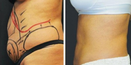 Laser liposuction of the abdomen. Photo, rehabilitation, consequences, price, reviews