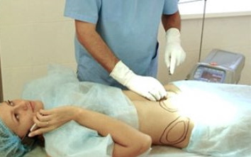 Laser liposuction of the abdomen. Photo, rehabilitation, consequences, price, reviews