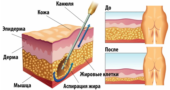 Laser liposuction of the abdomen. Photo, rehabilitation, consequences, price, reviews