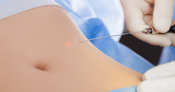 Laser liposuction of the abdomen. Photo, rehabilitation, consequences, price, reviews