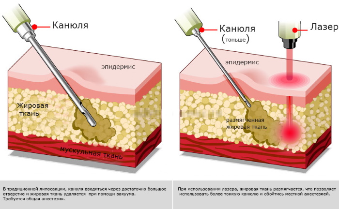 Laser liposuction of the abdomen. Photo, rehabilitation, consequences, price, reviews