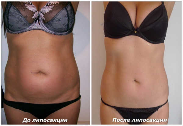 Laser liposuction of the abdomen. Photo, rehabilitation, consequences, price, reviews