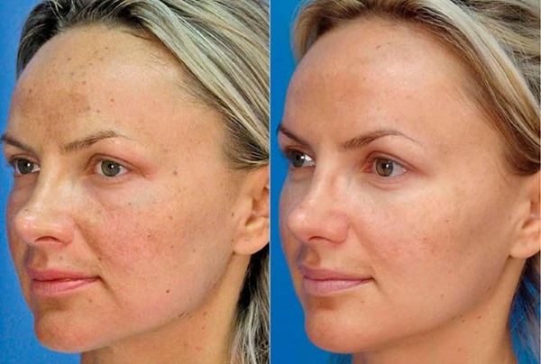 Diamond resurfacing (cleaning) of the face. Reviews, photos before and after peeling