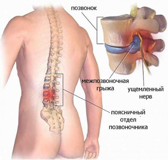 Ponte gluteo. Tecnica di esecuzione con bilanciere, elastico, pancake, su una gamba, pavimento, panca, in fabbro