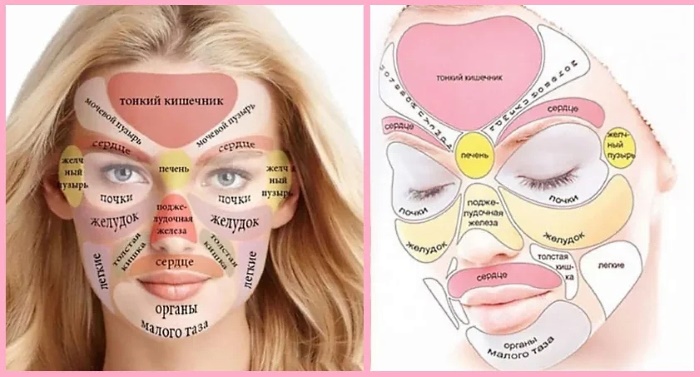 Mappa dell'acne sul viso delle donne, del collo, del corpo. Cosa significano le ragioni per zone, organi