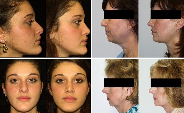 Facial contouring from the double chin. Photos before and after surgery, price, reviews