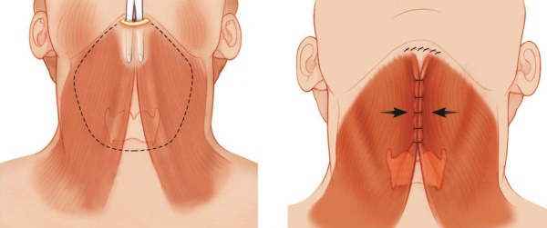 Facial contouring from the double chin. Photos before and after surgery, price, reviews