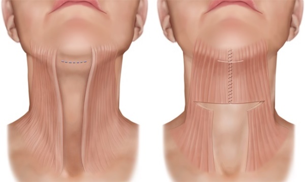 Facial contouring from the double chin. Photos before and after surgery, price, reviews