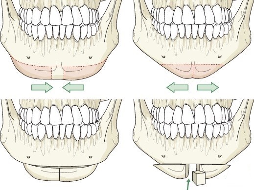 Facial contouring from the double chin. Photos before and after surgery, price, reviews