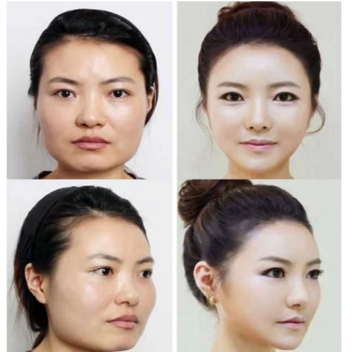 Beautiful girls 16-17-18 years old before and after plastic surgery. A photo