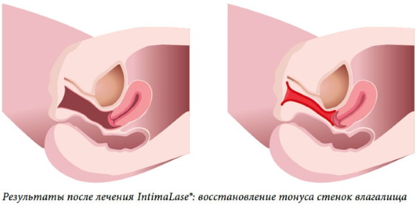 Laserverjüngung der Vagina (Vaginoplastik nach der Geburt). Bewertungen, Preis