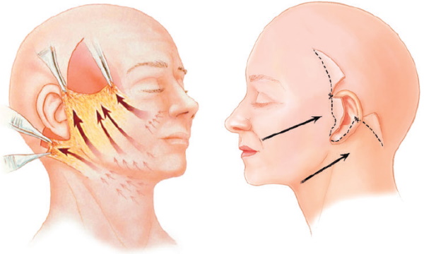 Neck wrinkles. How to get rid of, exercises, fillers, contour plastics, injections