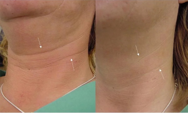 Neck wrinkles. How to get rid of, exercises, fillers, contour plastics, injections