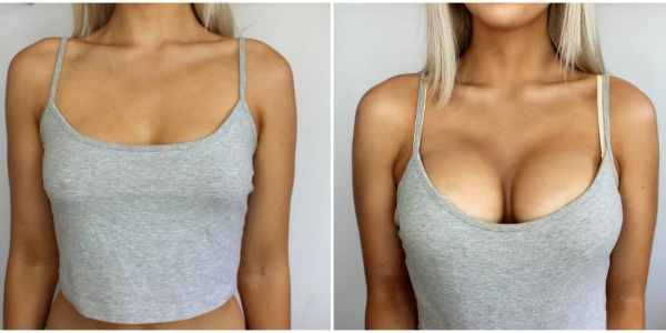 Where to get breast plastic surgery. Prices, reviews, photos before and after