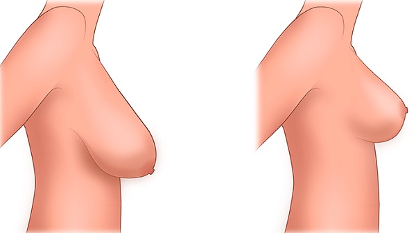 Where to get breast plastic surgery. Prices, reviews, photos before and after