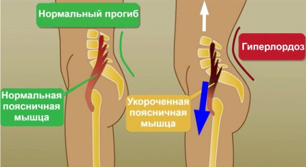 Iliopsoas muscle. Strengthening exercises, stretching, how to pump up