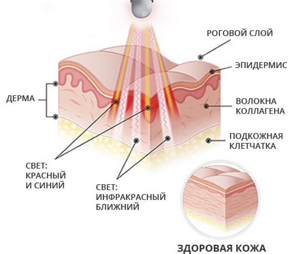 Phototherapy (light therapy, light therapy) of the face. What is it, before and after photos, reviews, price