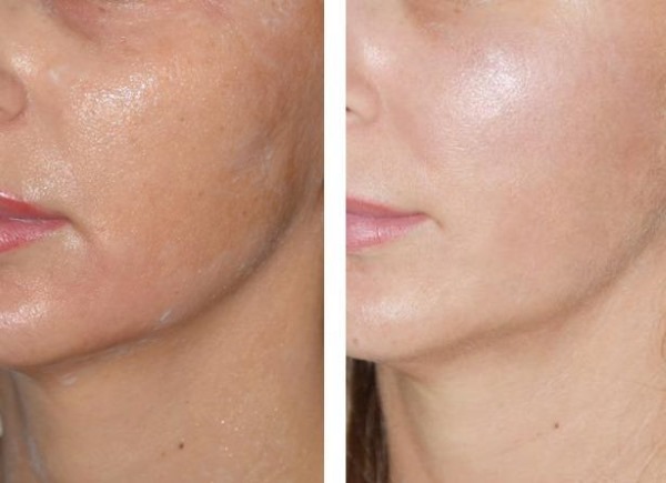 Phototherapy (light therapy, light therapy) of the face. What is it, before and after photos, reviews, price