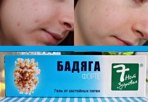 How to get rid of post acne at home. Means, cream, badyaga, peeling, scar correction, ointments