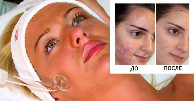 How to get rid of post acne at home. Means, cream, badyaga, peeling, scar correction, ointments