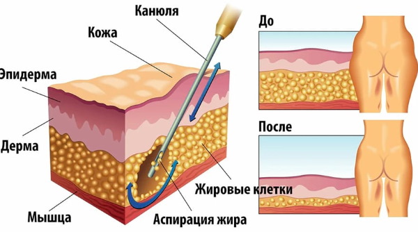 Liposuction of thighs, thick legs in women. Before and after photos, price, reviews