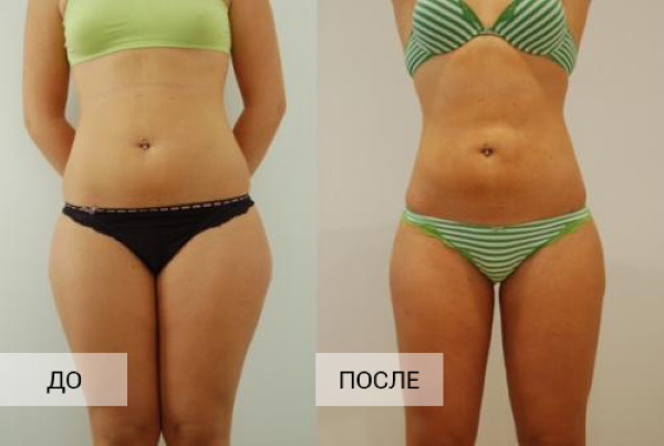 Liposuction of thighs, thick legs in women. Before and after photos, price, reviews