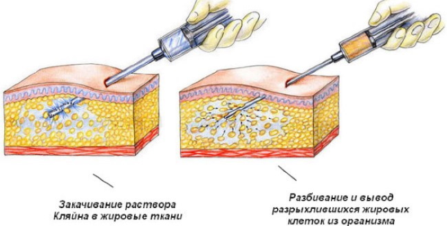 Liposuction of thighs, thick legs in women. Before and after photos, price, reviews