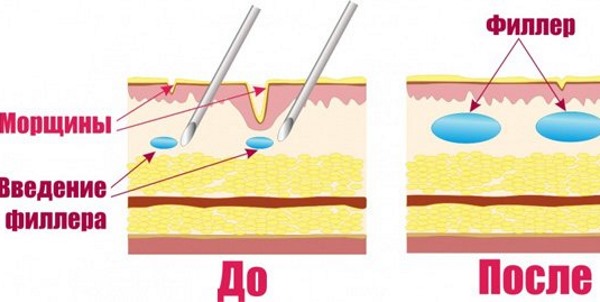 Filler Sculptra. Before and after photos, price, reviews