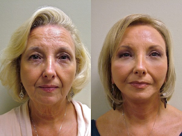 Filler Sculptra. Before and after photos, price, reviews