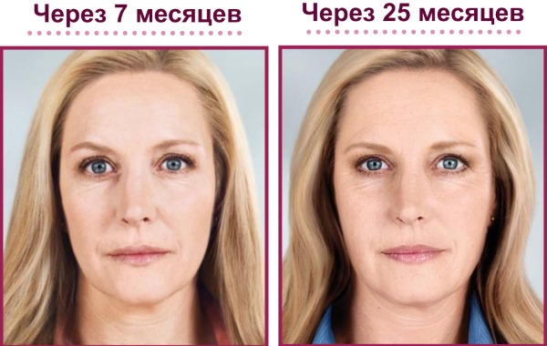 Filler Sculptra. Before and after photos, price, reviews