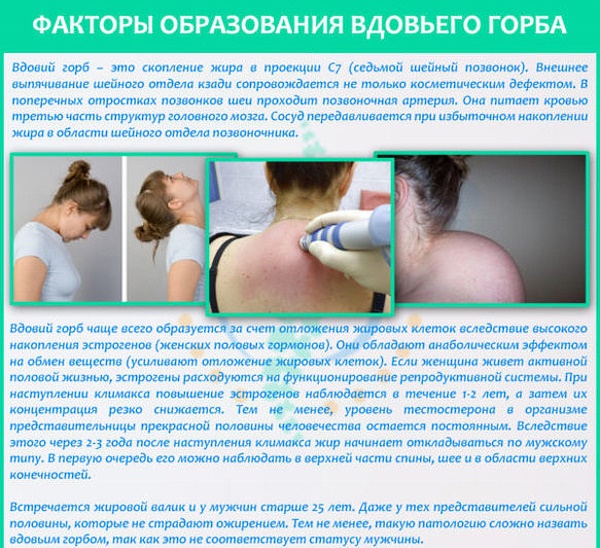 Exercises to remove a widow's hump. Video by Bubnovsky, Kurkurina, Shishonin