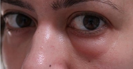 Botox under the eyes. Before and after photos, effects, reviews, consequences