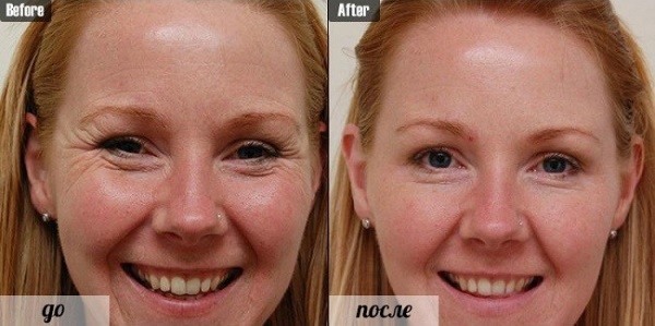 Botox under the eyes. Before and after photos, effects, reviews, consequences