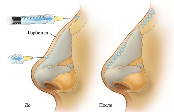 A hump on the girl's nose. Beautiful or not, how to remove without surgery, rhinoplasty