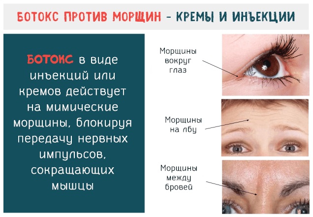 Botox analogs for the face of Russian production, France, Korea. Xeomin, Dysport, Relatox