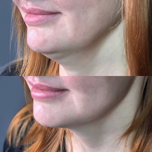 Lipolytics for the double chin. Price, photo, reviews