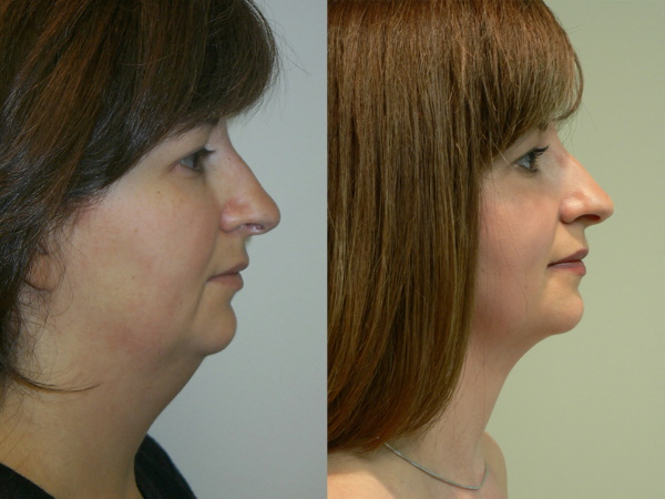 Lipolytics for the double chin. Price, photo, reviews