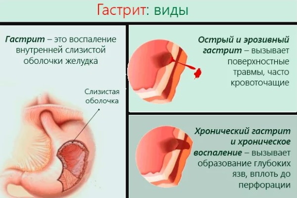 Nicotine (nicotinic acid) in injections. Instructions, indications for use, course of treatment