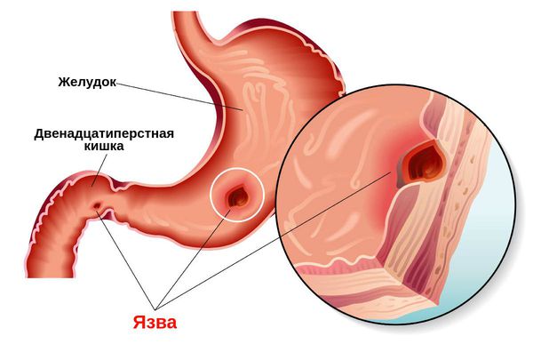 Nicotine (nicotinic acid) in injections. Instructions, indications for use, course of treatment