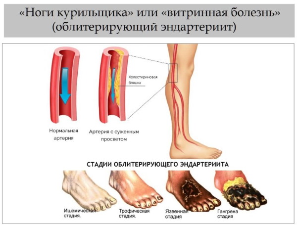 Nicotine (nicotinic acid) in injections. Instructions, indications for use, course of treatment