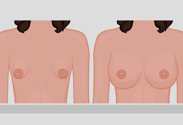 Tubular form of mammary glands, breasts. Photo, correction without surgery for women, men