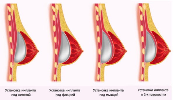 Forma tubulare di ghiandole mammarie, seno. Foto, correzione senza chirurgia per donne, uomini