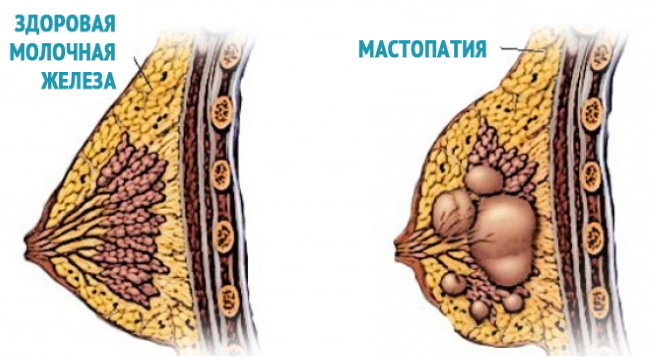 Tubular form of mammary glands, breasts. Photo, correction without surgery for women, men