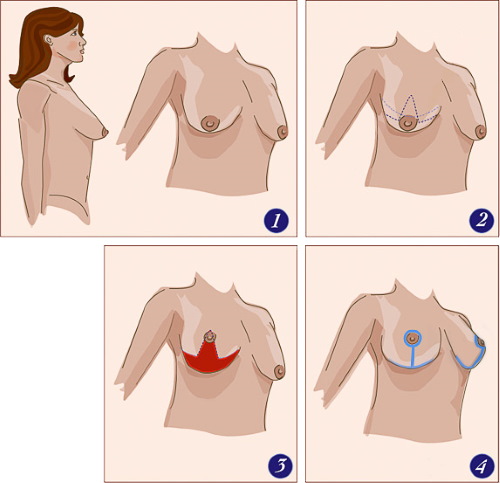 Tubular form of mammary glands, breasts. Photo, correction without surgery for women, men