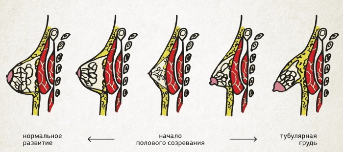 Forma tubulare di ghiandole mammarie, seno. Foto, correzione senza chirurgia per donne, uomini