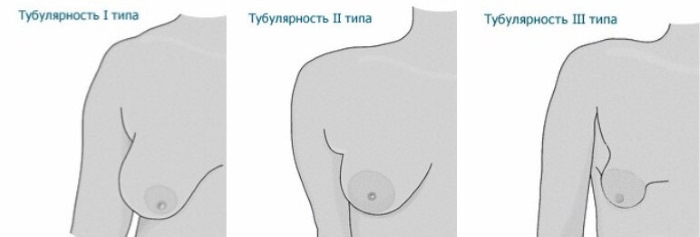 Tubular form of mammary glands, breasts. Photo, correction without surgery for women, men